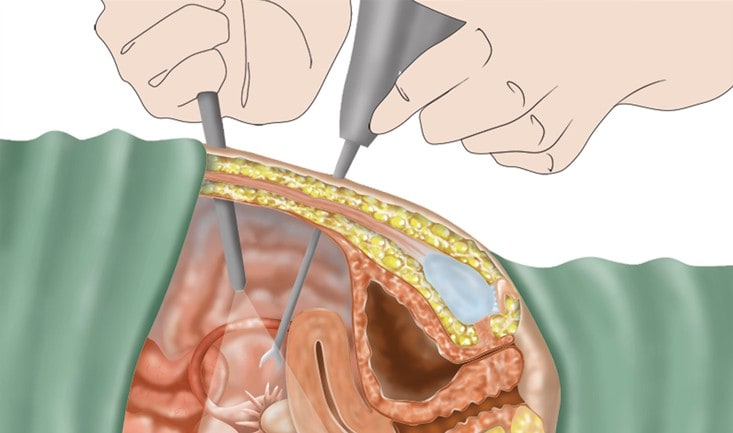 Varicele este o contraindicație pentru laparoscopia vezicii biliare