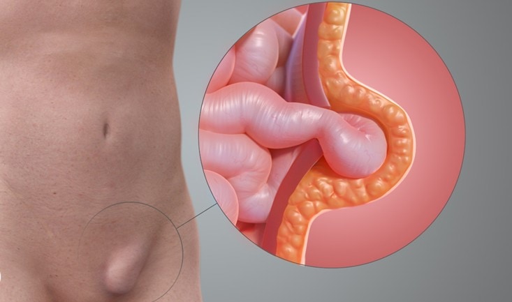 Hernia varicoza, Care este varicoza abdominală - Cauze și simptome