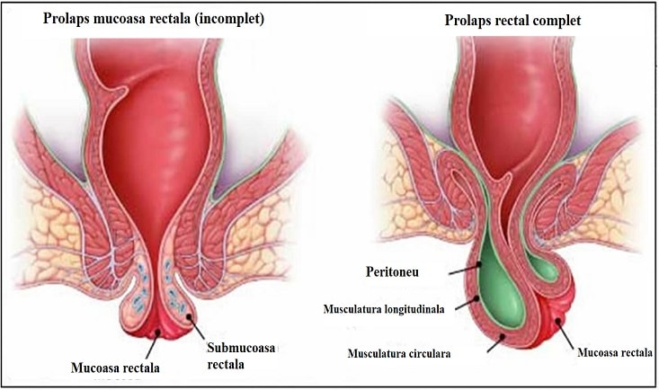 Cum se trateaza prolapsul rectal? - Tratament