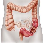 Cancerul de colon|Cancerul colorectal