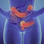 Cancerul rectal